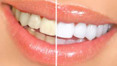 Does Teeth Whitening Work on Crowns, Fillings, or Veneers?