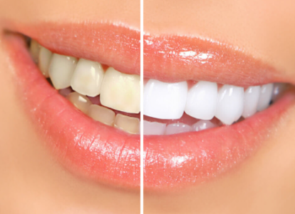 Does Teeth Whitening Work on Crowns, Fillings, or Veneers?