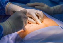 Premier Hernia Surgeon